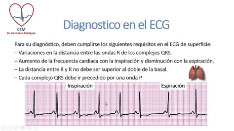 arritmia sinusal cardiaca en niños